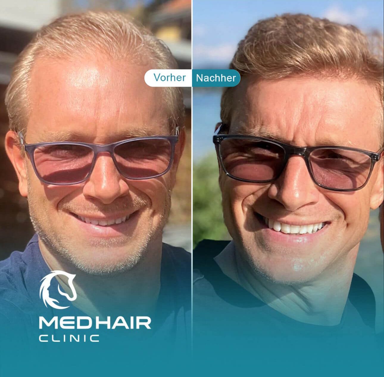 Haartransplantation vorher nachher Ergebnis von Jürgen -Patientenbewertung