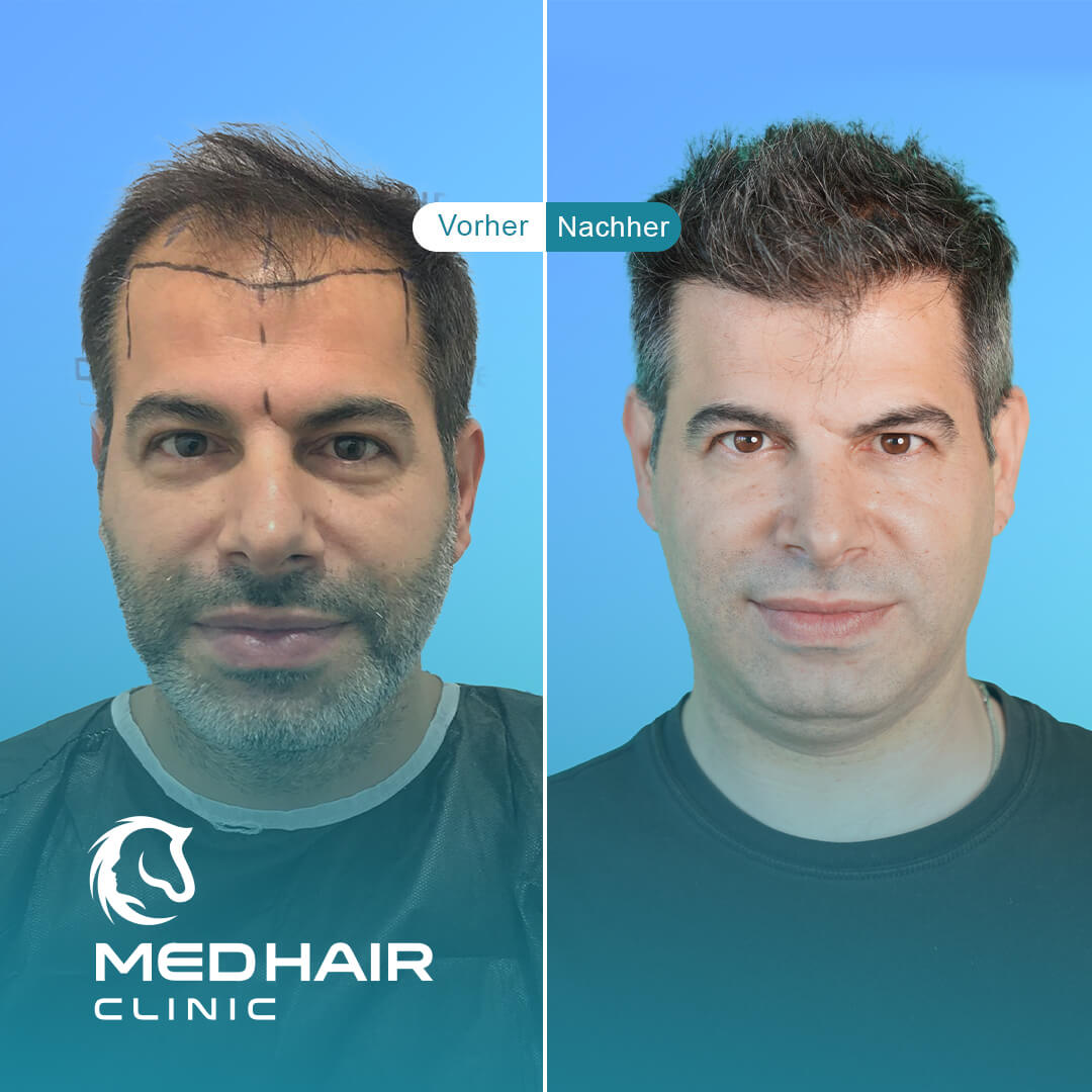 Haartransplantation von Peter mit 3400 Grafts mit der DHI Methode
